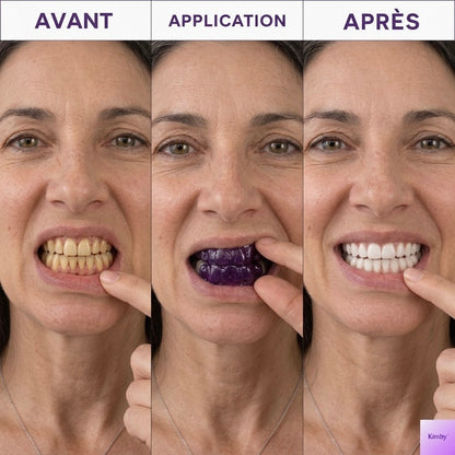 Bandes Blanchissantes Kimby™ (sans peroxyde)