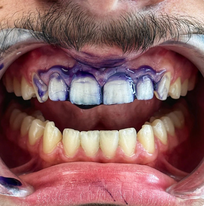 Sérum Blanchissant v34